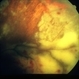 Wegener's Granulomatosis
